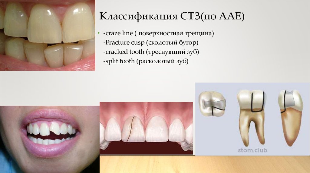 Трещина и раскол коронки зуба - online presentation