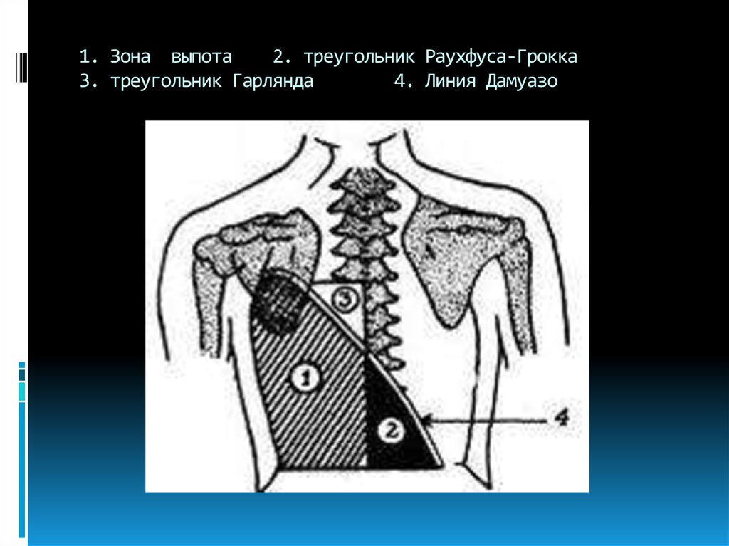 Перкуторная картина у больных с экссудативным плевритом