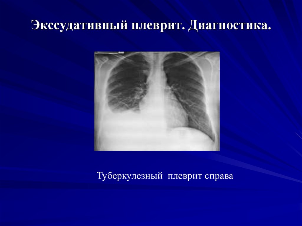 Экссудативный плеврит при пневмонии. Экссудативный плеврит. Экссудативный плеврит рентген. Экссудативный плеврит выпот.