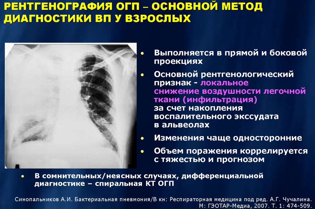 Кт огп. Рентгенография ОГП. Рентгенодиагностика пневмоний. Рентген пневмония не Больничная. Внебольничная пневмония рентген.