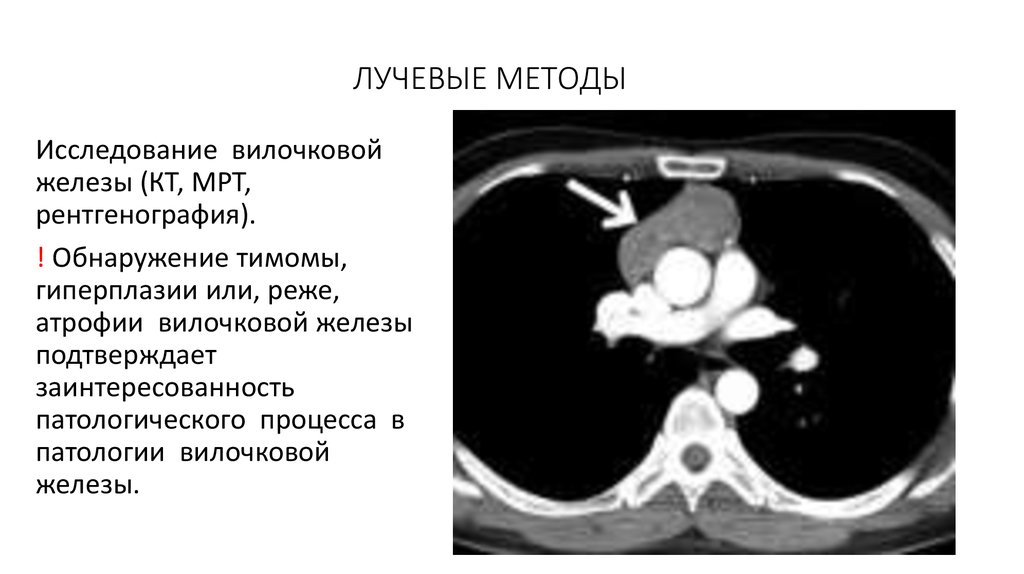 Тимома кт картина