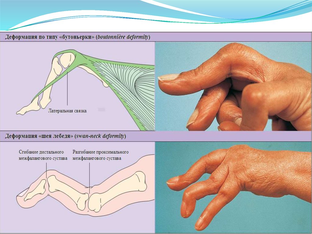 Потянул палец руки. Контрактура при ревматоидном артрите. Ревматоидный артрит деформация кисти. Разрыв сухожилий разгибателей кисти. Повреждения разгибателей 1 пальца кисти.
