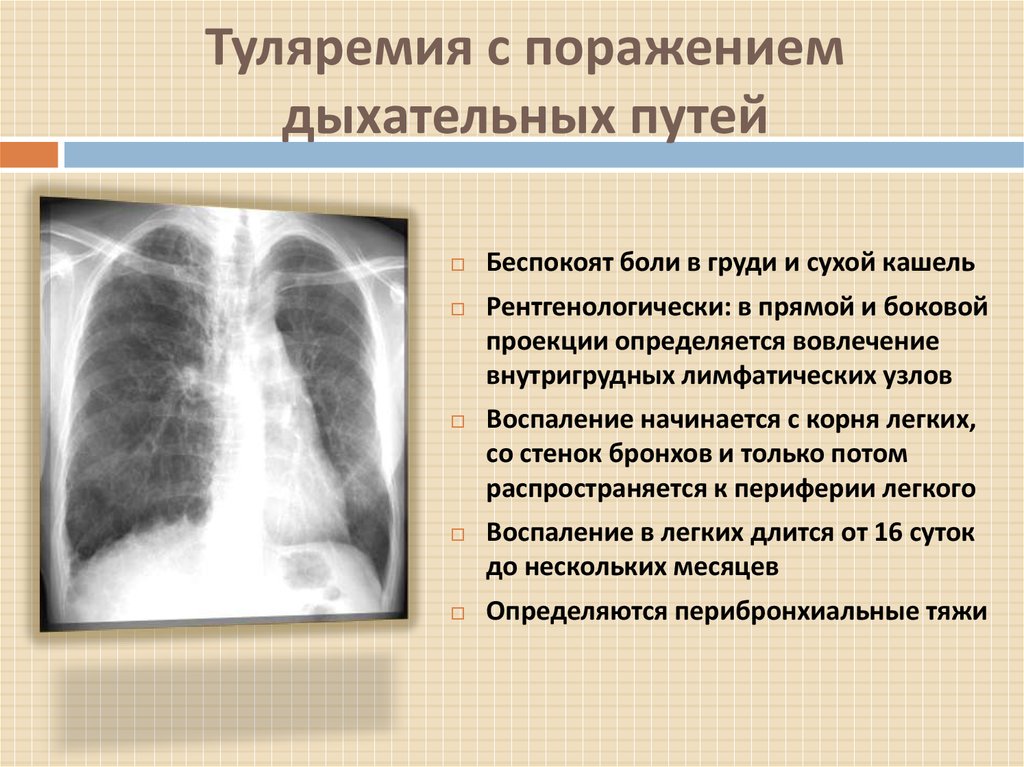 Туляремия с поражением дыхательных путей
