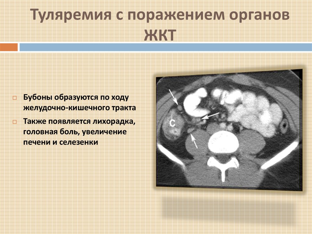 План обследования при туляремии