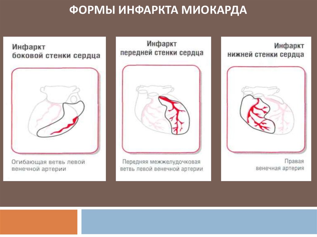 Формы инфаркта миокарда. Формы инфпатп мтокарда. Фиоры инфаркиа миокарда. Формы инфаркта. Инфаркт миокарда формы инфаркта.