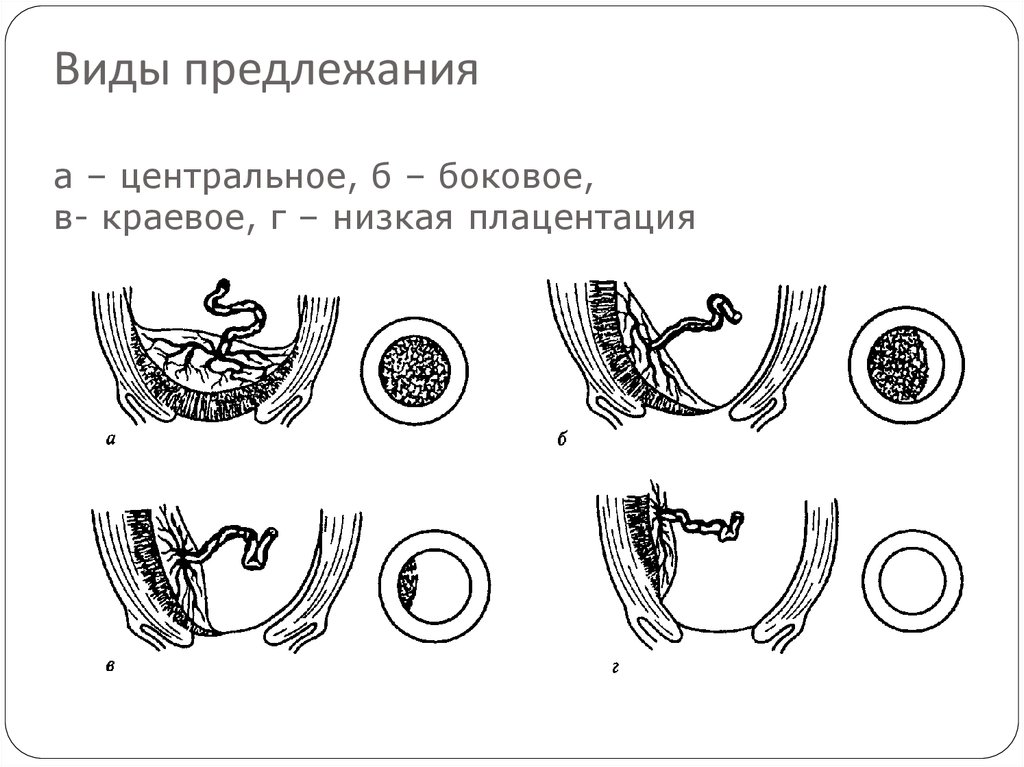 Клиническая картина предлежания плаценты