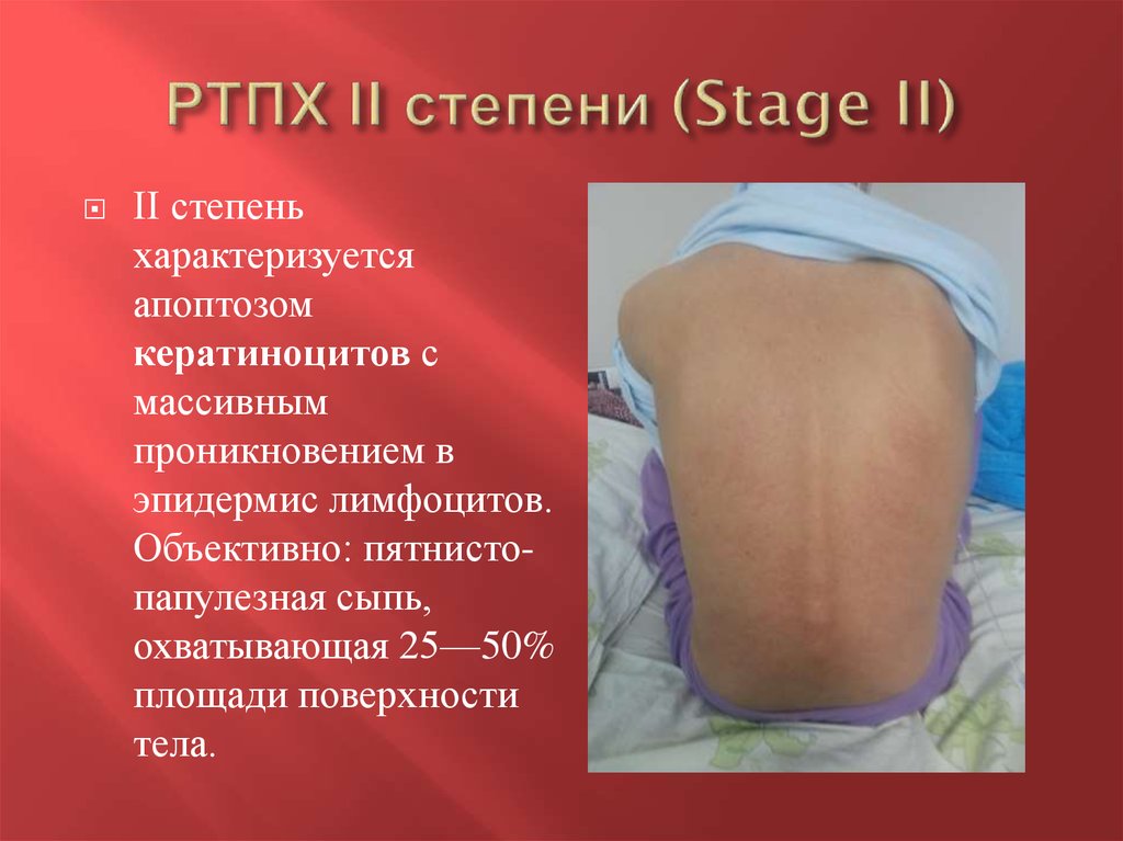 РТПХ II степени (Stage II)