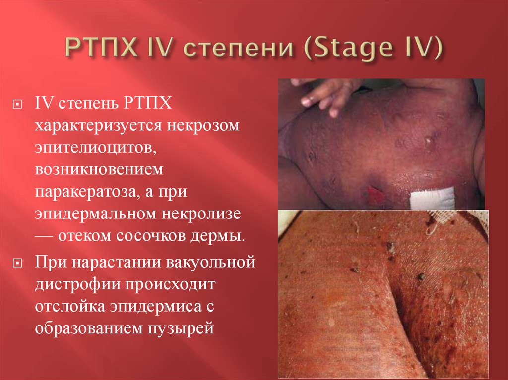 РТПХ IV степени (Stage IV)