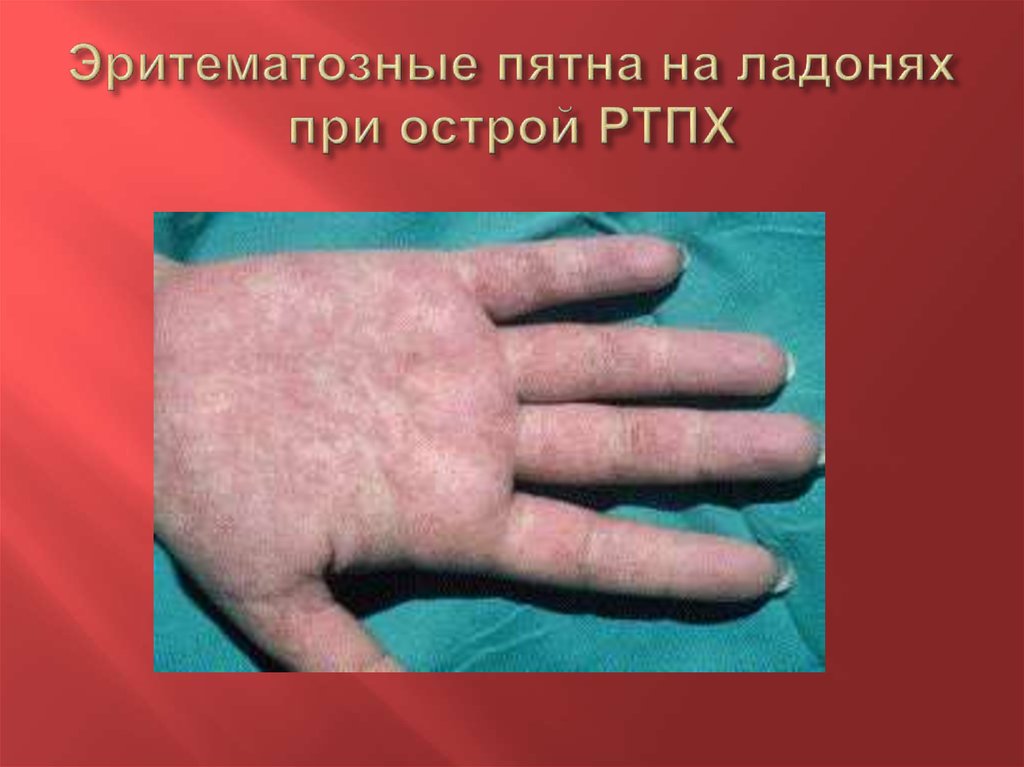 Эритематозные пятна на ладонях при острой РТПХ