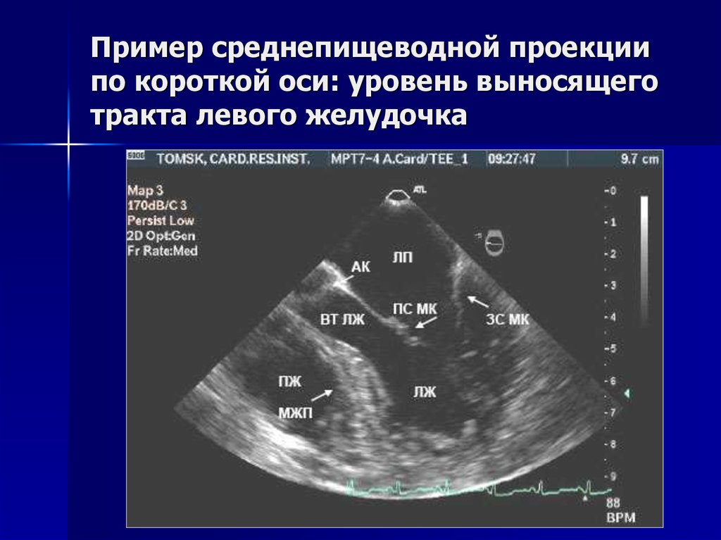 Картине истинной аневризмы в области верхушки миокарда левого желудочка соответствует