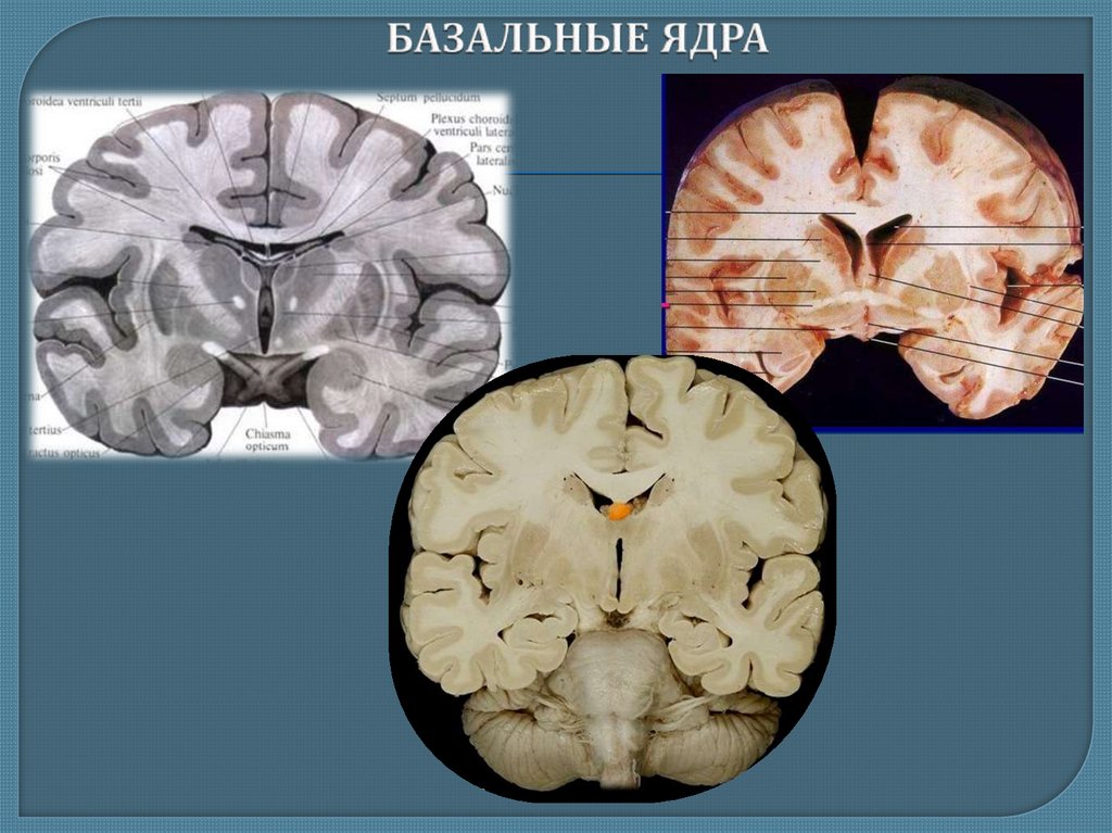 Изменение в базальных отделах. Базальные (подкорковые) ядра конечного мозга. Важнейшие подкорковые базальные ядра. Базальные ядра анатомия. Скорлупа базальные ядра.