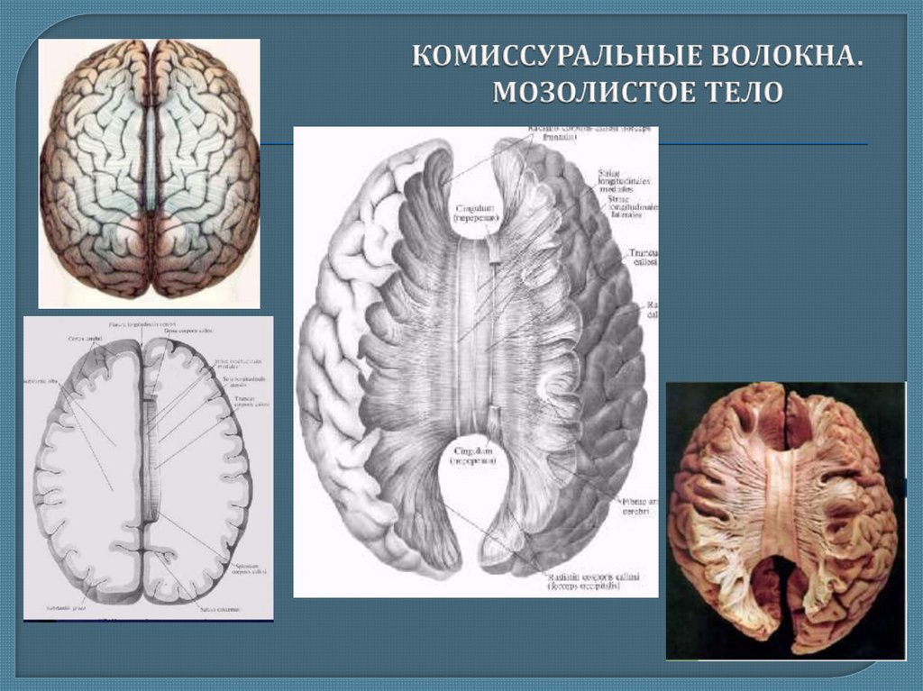 Рассечение мозолистого тела