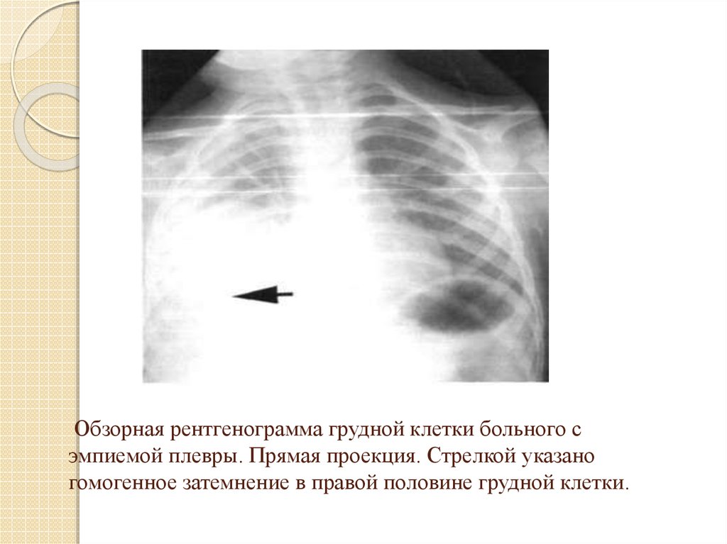 Гидроторакс карта вызова. Эмпиема легких рентген. Обзорная генограмма грудной клетки. Обзорная рентгенограмма грудной клетки. Рентгенограммы грудной клетки прямая проекция.