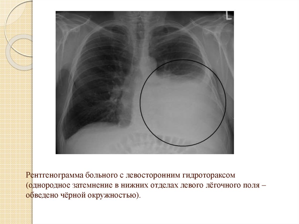 Почему на рентгеновском снимке изображение газа в плевральной полости черное