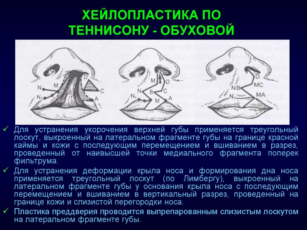 Треугольный лоскут. Хейлопластика Лимберга. Хейлопластика метод Лимберга. Хейлопластика методики. Операции при расщелинах верхней губы.