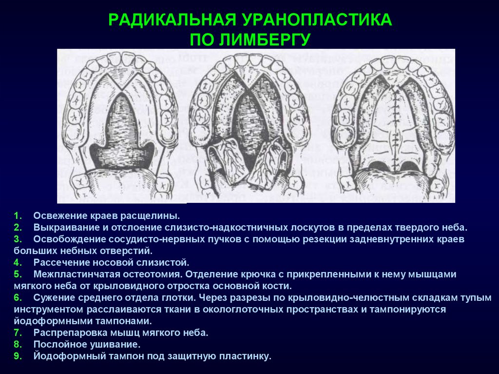 Виды расщелин при ринолалии картинки