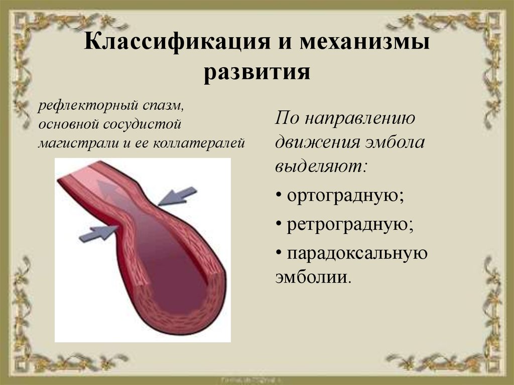 Ретроградная эмболия