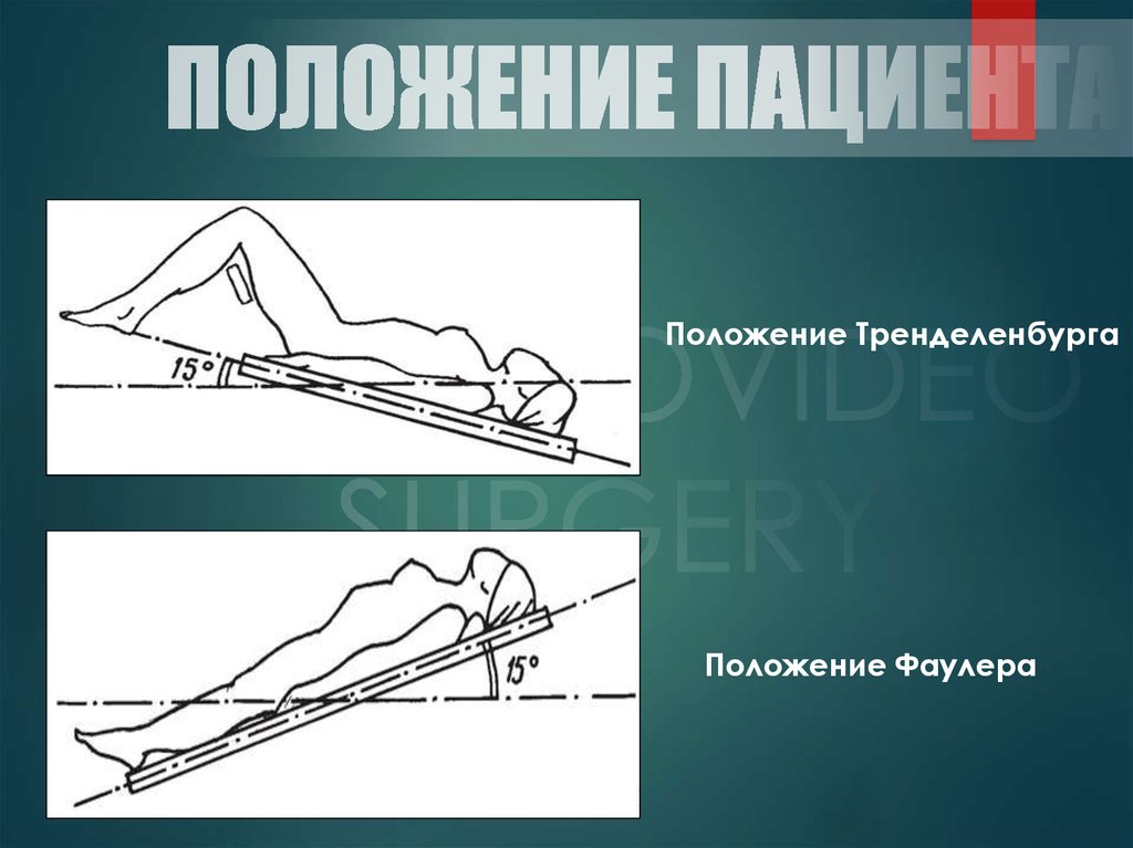 Положение тренделенбурга картинки