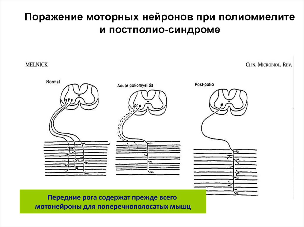 Аксональное поражение моторных волокон