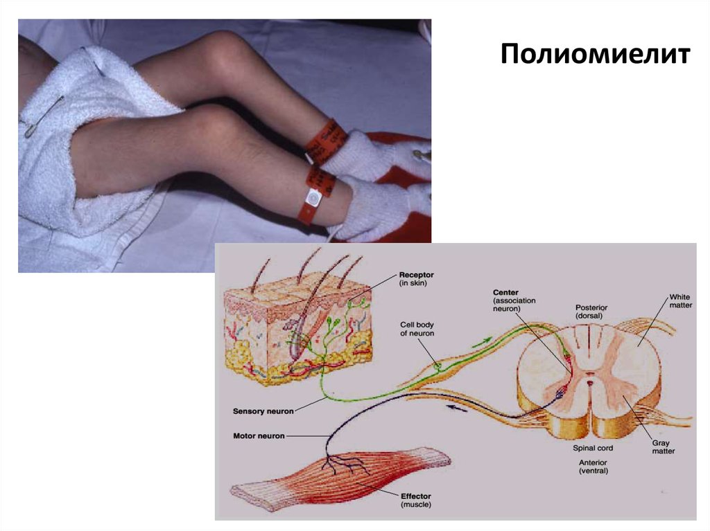 Презентация на тему полиомиелит