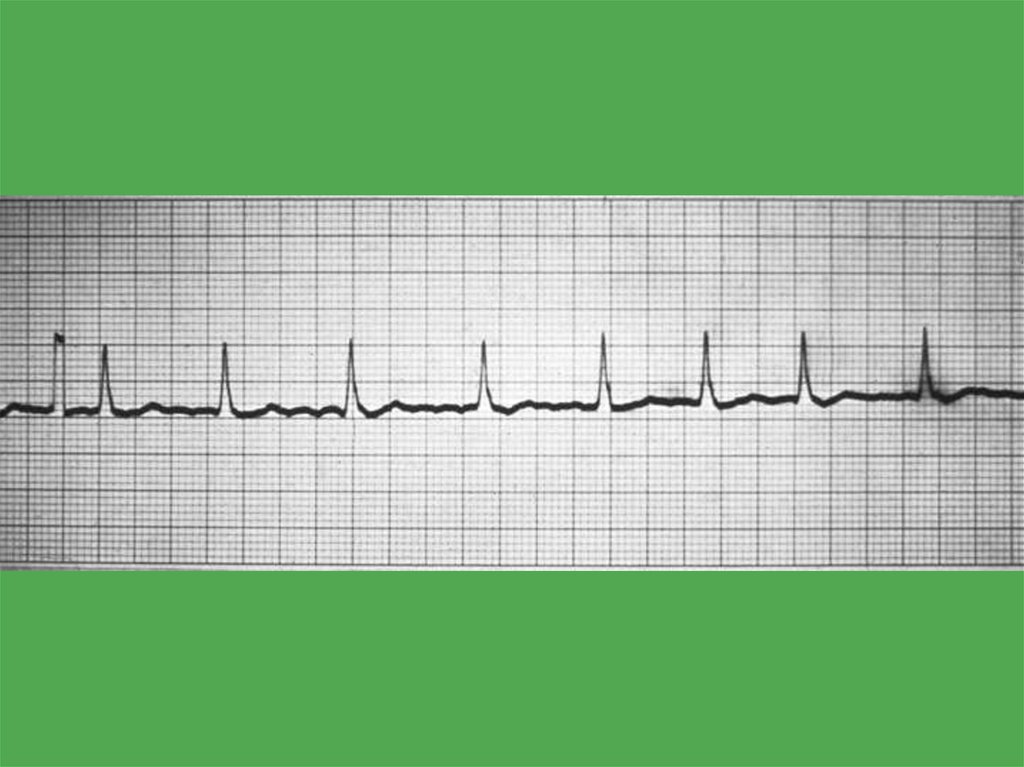 Экг при тиреотоксикозе картинки
