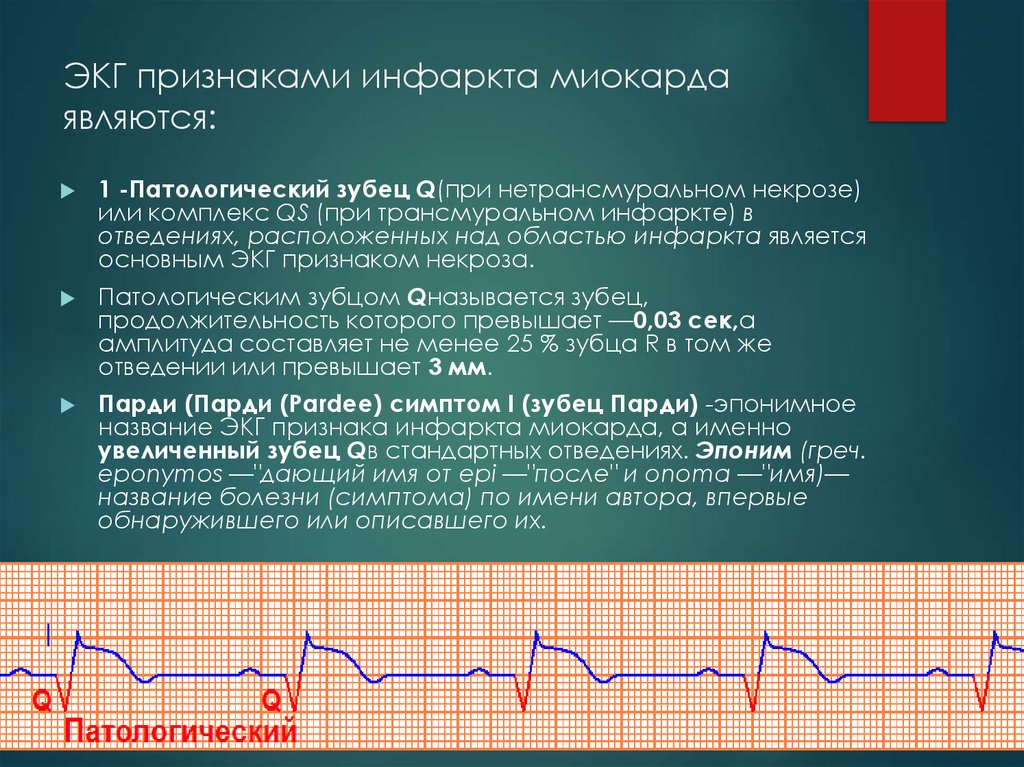 Острый инфаркт миокарда на экг фото