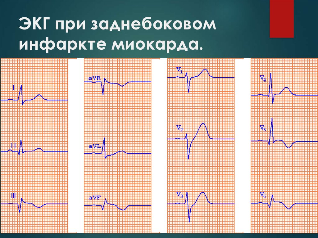 Инфаркт миокарда на экг. ЭКГ при заднебоковом инфаркте миокарда.