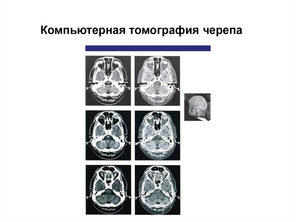 Кт анатомия черепа. Анатомия основания черепа на кт. Кости основания черепа анатомия кт. МСКТ анатомия основания черепа. Кт компьютерная томография черепа.