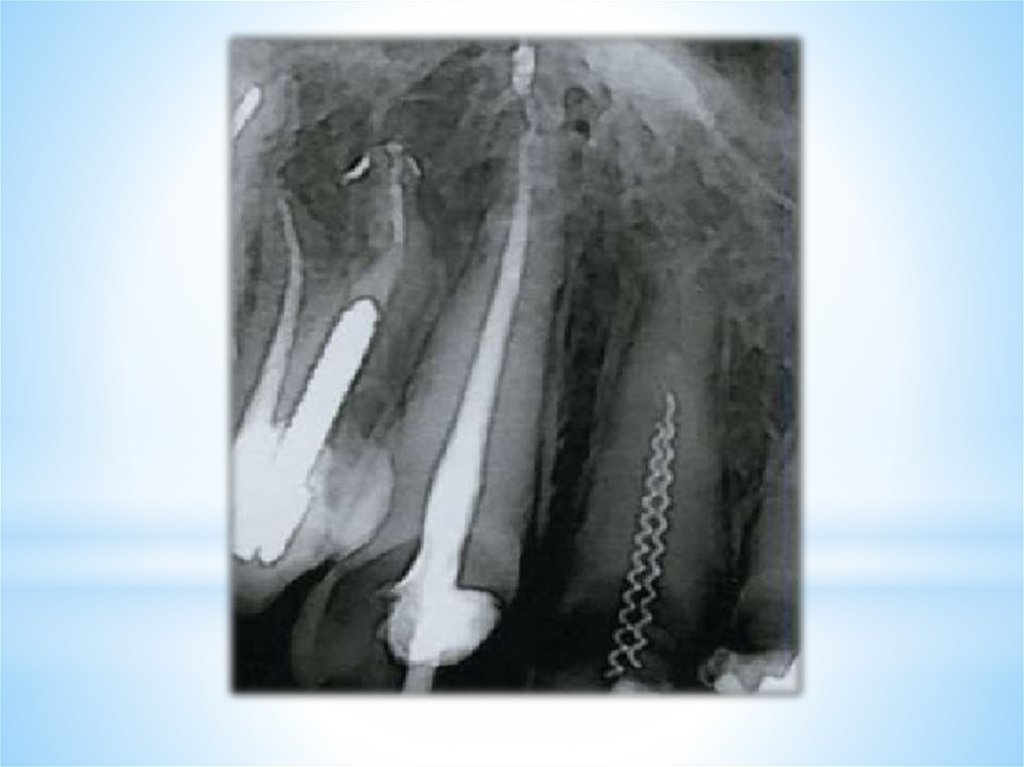 После эндодонтического лечения. Ошибки при эндодонтическом лечении. Отлом инструмента в корневом канале. Осложнения эндодонтического лечения. Перфорация стенки корневого канала.