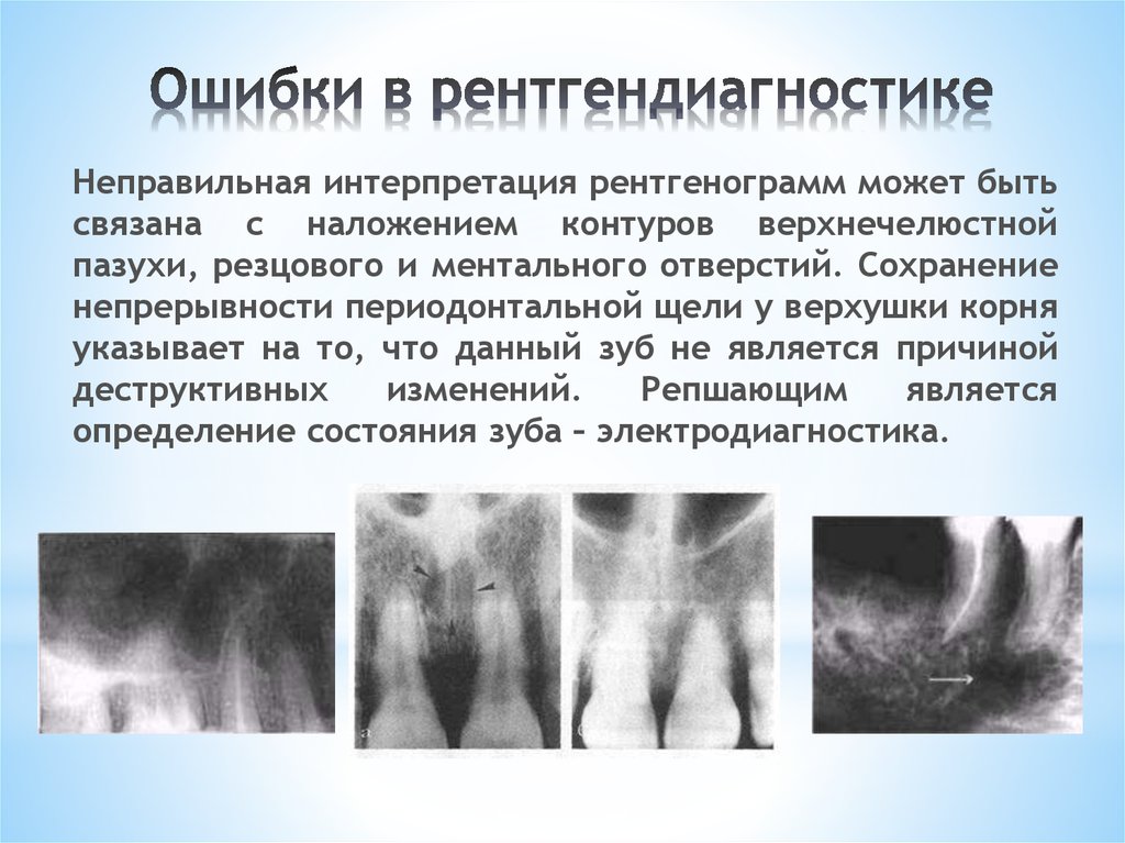 Осложнения эндодонтического лечения. Интерпретация рентгенограммы. Ошибки интерпретации рентгенограммы. Ошибки при интерпретации рентгенологических снимков. Ошибки и осложнения в эндодонтии.