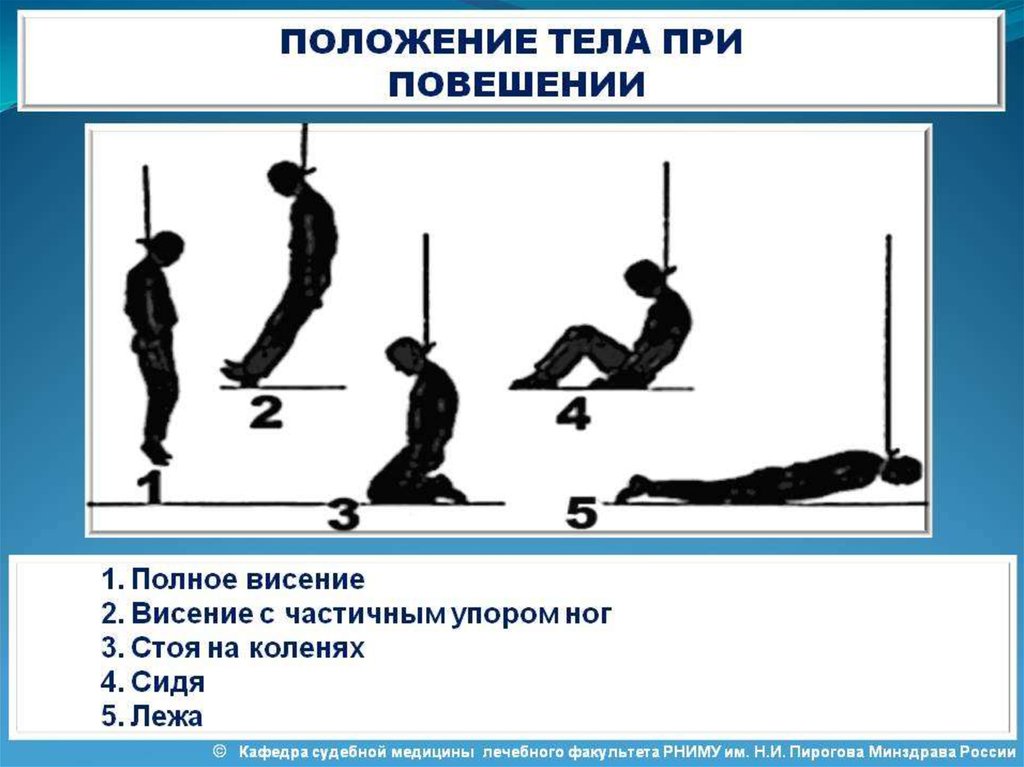 Высота положения тела. Положение тела при повешении. Положение трупа при повешении. Различные положения тела при повешении. Опишите положения тела.