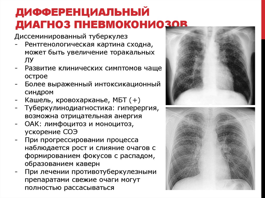 Клинический случай туберкулез. Диссеминированный туберкулез дифференциальный диагноз. Дифференциальный диагноз диссеминированного туберкулеза. Диссеминированный туберкулез легких дифф. Диссеминированный туберкулёз лёгких рентген.