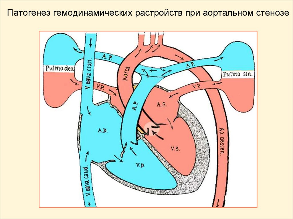 Гемодинамика митральный стеноз схема