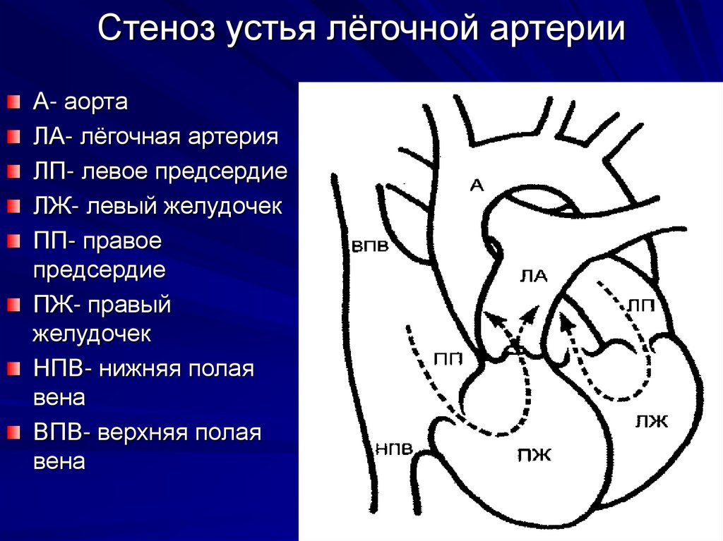 Стеноз это. Акцент II тона на легочной артерии. Усиление II тона на легочной артерии. Систолический шум на легочной артерии. Пороки развития легочной артерии.