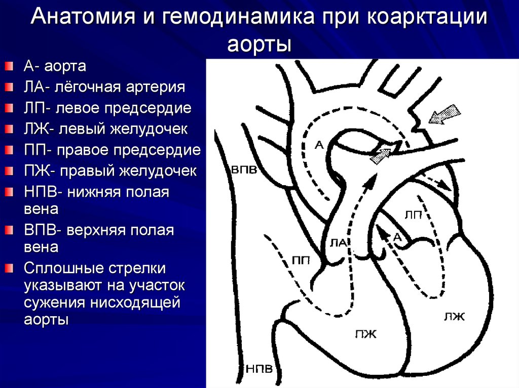 Открытый артериальный проток схема