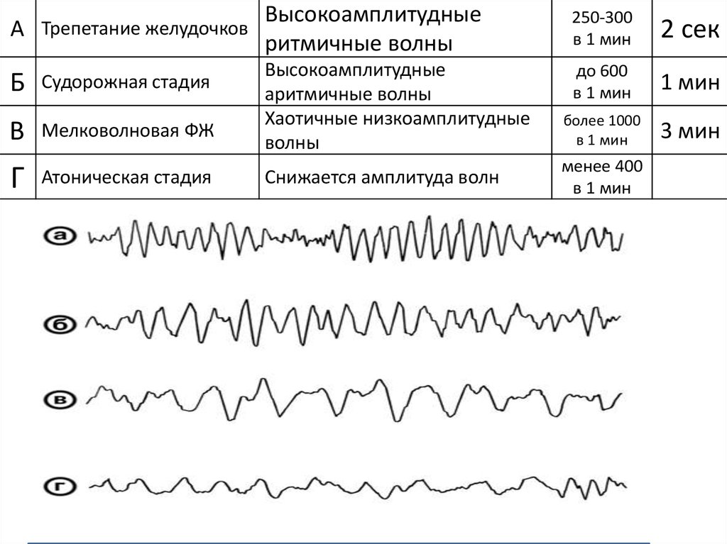 Фибрилляция желудочков на экг картинки