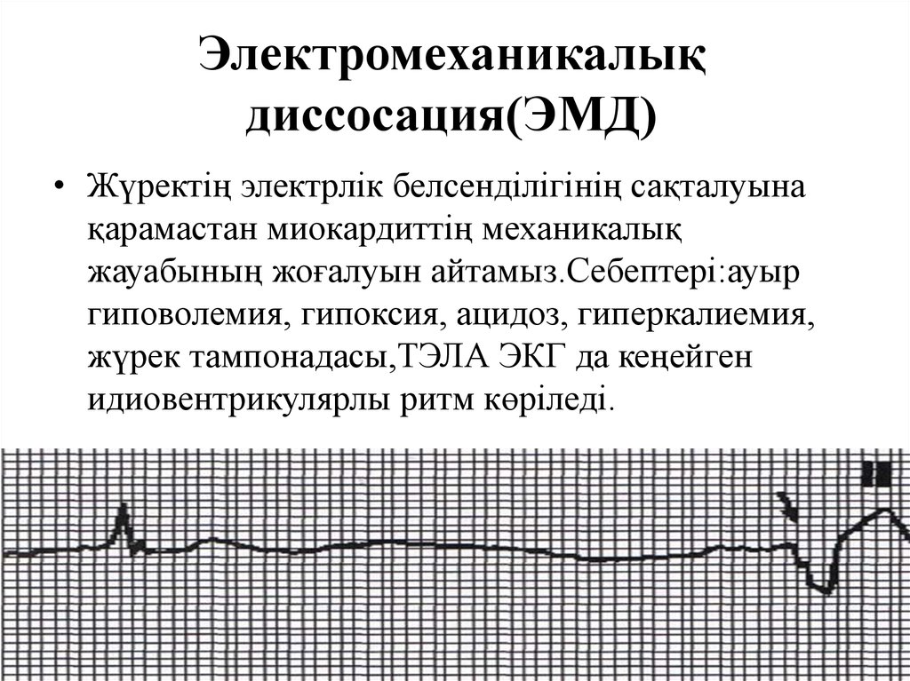 Признаки электромеханической диссоциации