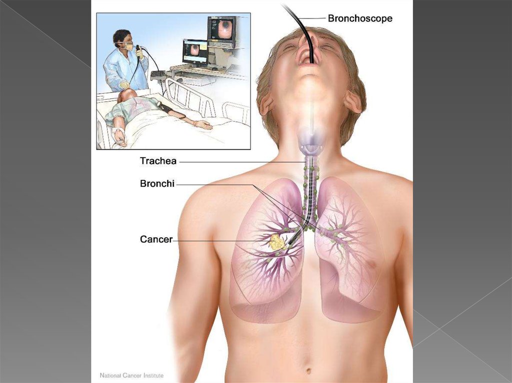 Как делают биопсию легких