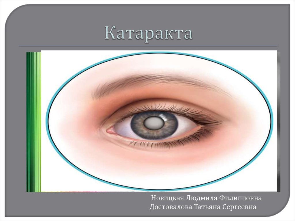 Презентация на тему катаракта