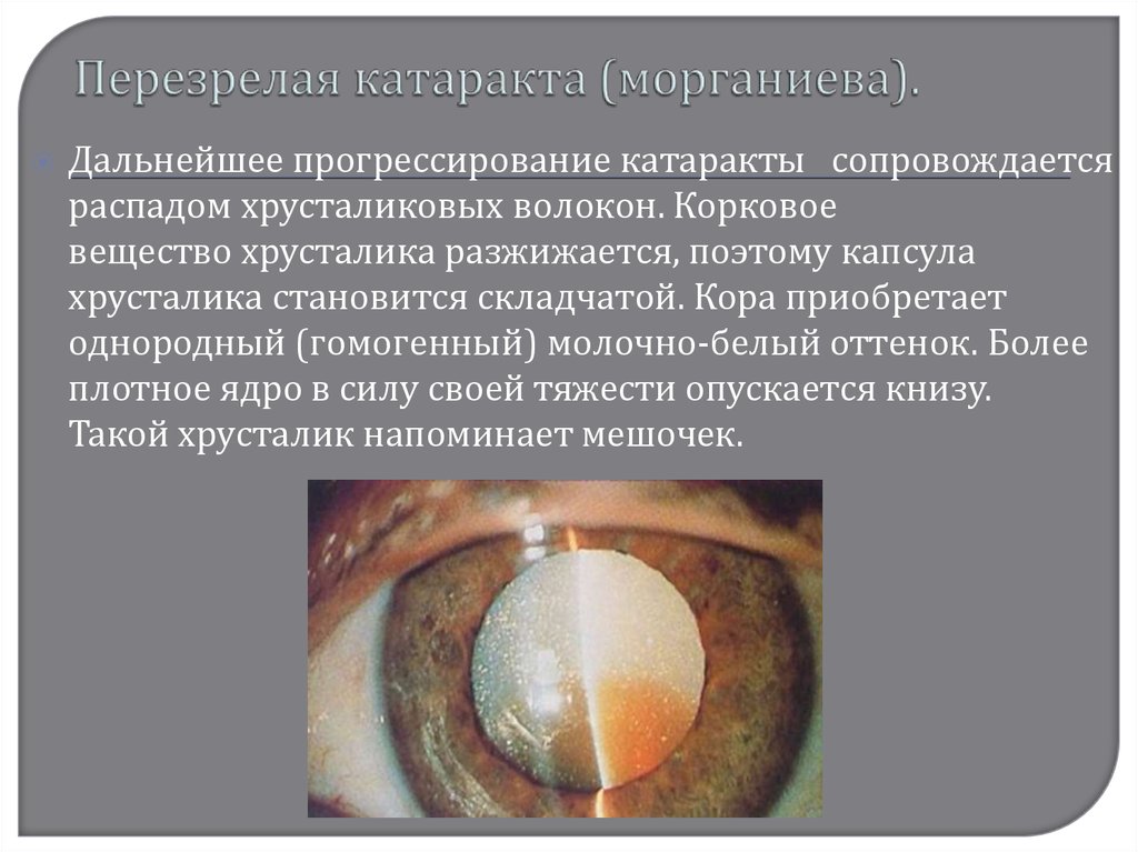 Начальная старческая катаракта. Старческая морганиева катаракта. Перезрелая (морганиева) катаракта. Миопизирующая катаракта. Катаракта морганиева катаракта.