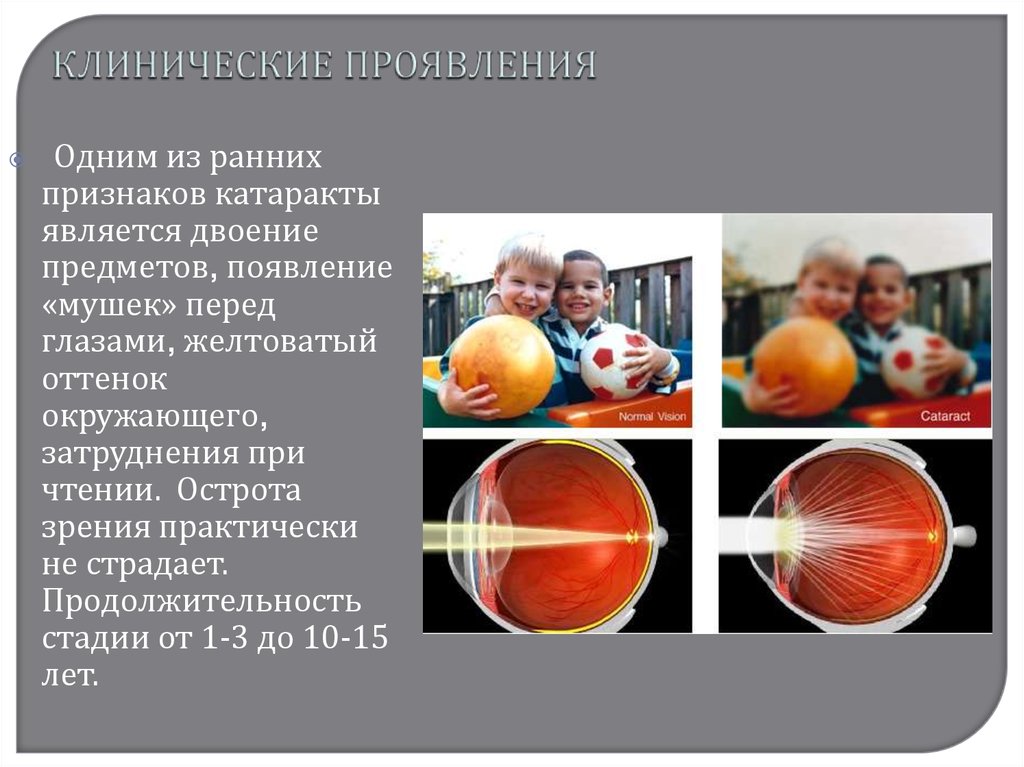 Проявленной одной из сторон. Клинические проявления катаракты. Презентация на тему катаракта.