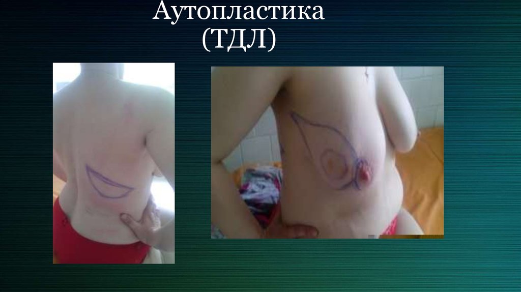 Аутопластика (ТДЛ)