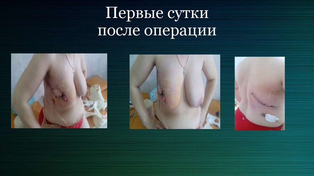 Первые сутки после операции