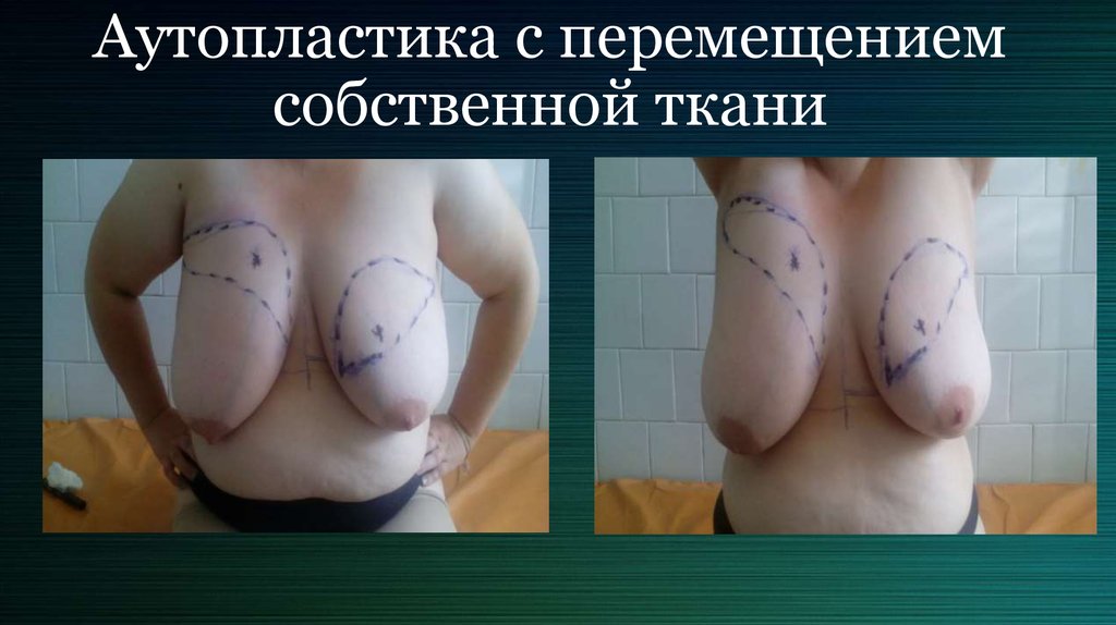 Аутопластика с перемещением собственной ткани