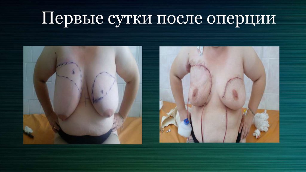 Первые сутки после оперции