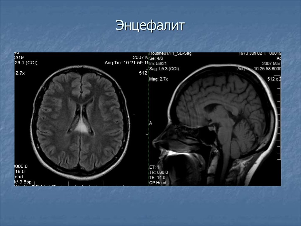 Энцефалит мозга. Мезэнцефальный энцефалит. Вторичный энцефалит головного мозга. Клещевой энцефалит мрт.