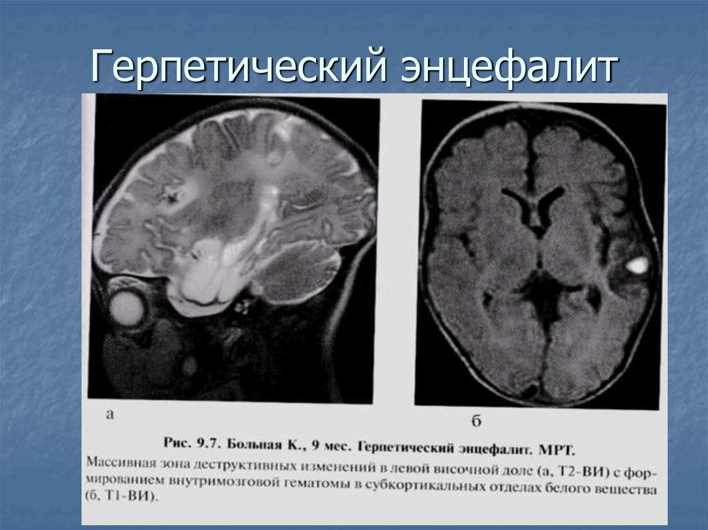 Энцефалит мозга у взрослых