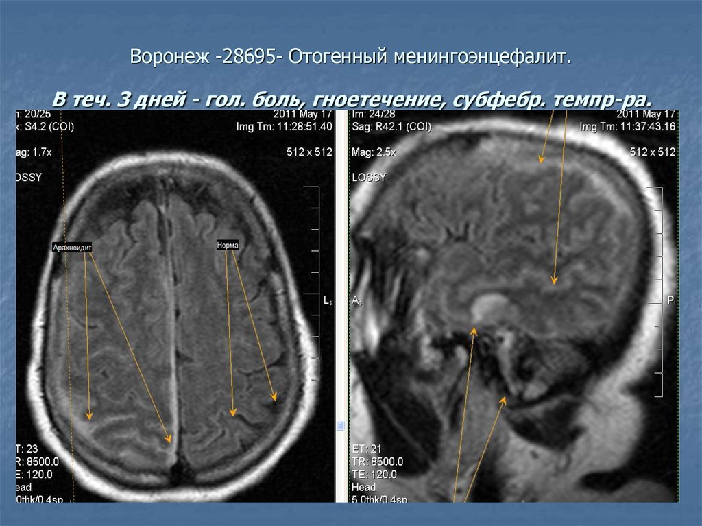 Отогенный менингит презентация