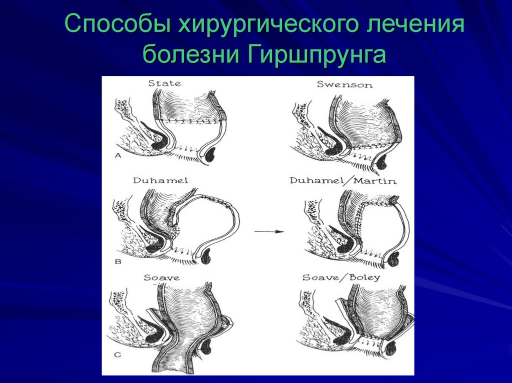 Схема изменений толстой кишки при болезни гиршпрунга