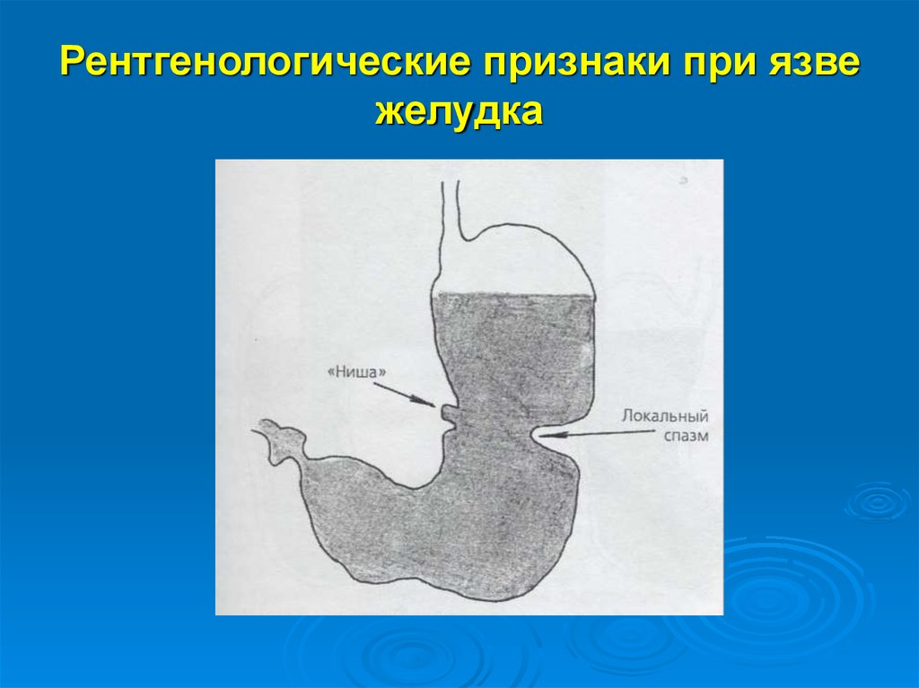 Язва малой кривизны желудка схема